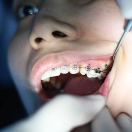 Ein Zahnarzt kontrolliert die Zahnspange eines Kindes.